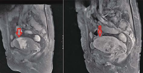 Myometrial invasion extending to serosa in the T2-weighted and T1 ...