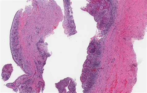 Pathology Outlines - Dentigerous cyst