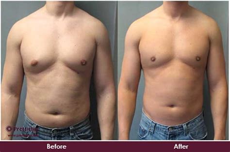 Gynecomastia Treatment Without Surgery in Mumbai | Prettislim