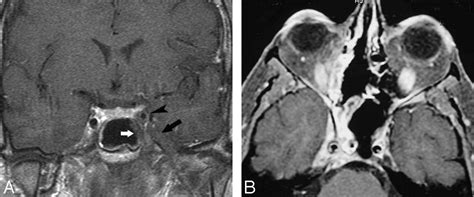 Imaging Lesions of the Cavernous Sinus | American Journal of Neuroradiology