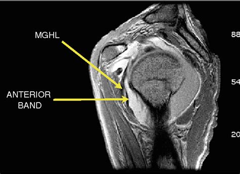 Inferior Glenohumeral Ligament Mri