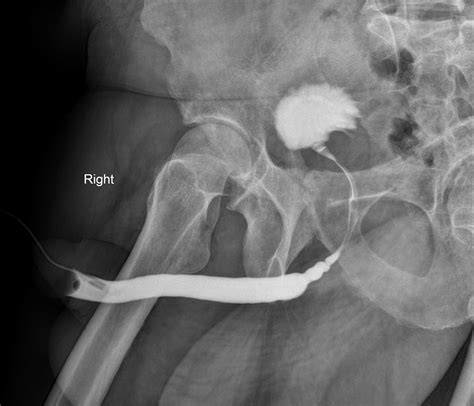 Bulbar urethral stricture | Image | Radiopaedia.org