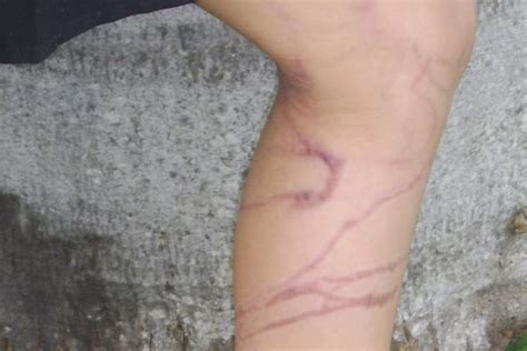 Box jellyfish scars on inside of 10-year-old Rachael Shardlow's legs in April, 2010. - ABC News ...