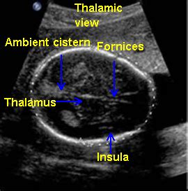 Free Chapter: Normal CNS Ultrasound Brain Anatomy - OB Images