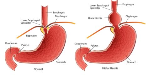 Hiatal Hernias