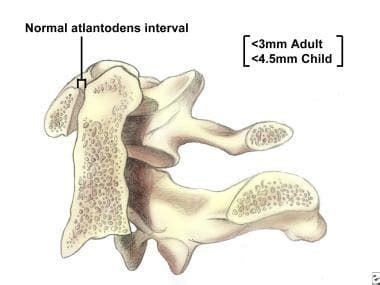 Atlantoaxial Instability