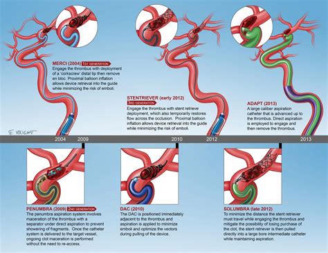 Evolution of thrombectomy approaches and devices for acute stroke: a technical review | Journal ...