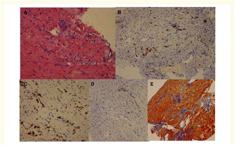 Myocardial histology confirming the diagnosis of acute myocarditis. (A)... | Download Scientific ...