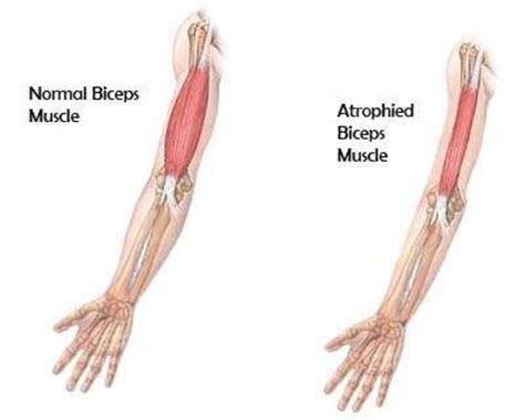 Are you Suffering from Muscle Atrophy? - HubPages