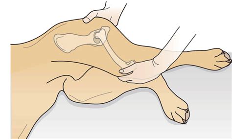 Palpating for the Ortolani Sign When Diagnosing Hip Dysplasia