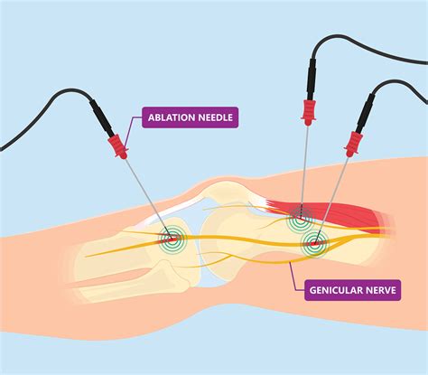 Should You Get Knee Nerve Ablation? - Regenexx