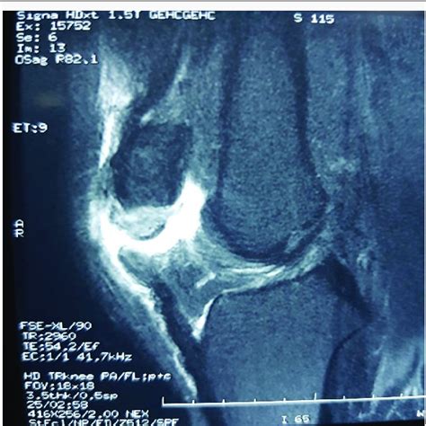 MRI showing complete patella tendon rupture. | Download Scientific Diagram