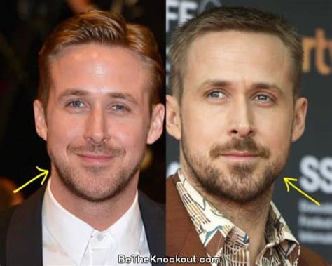 Ryan Gosling Plastic Surgery Comparison Photos