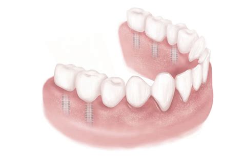 Bone Resorption | IDIA | The Dental Implant Guide