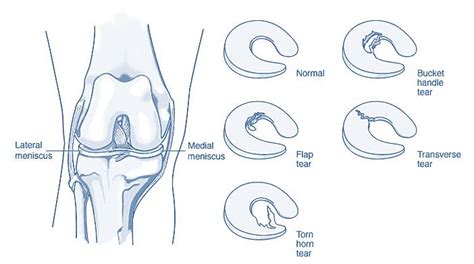 Knee Meniscus Tear treated without Surgery