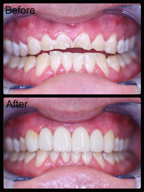 Veneers (Composite Resin) | Case Studies | BelleDental Newcastle