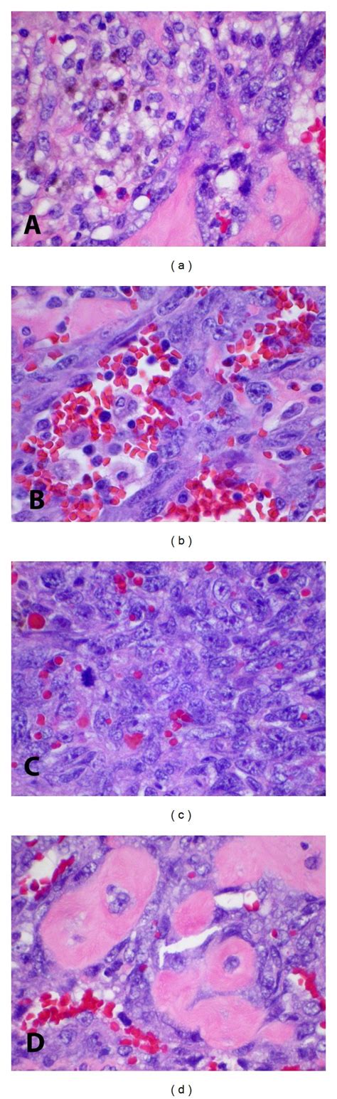 (a) Hemosiderin deposition in tumor; (b) anastomosing vascular... | Download Scientific Diagram