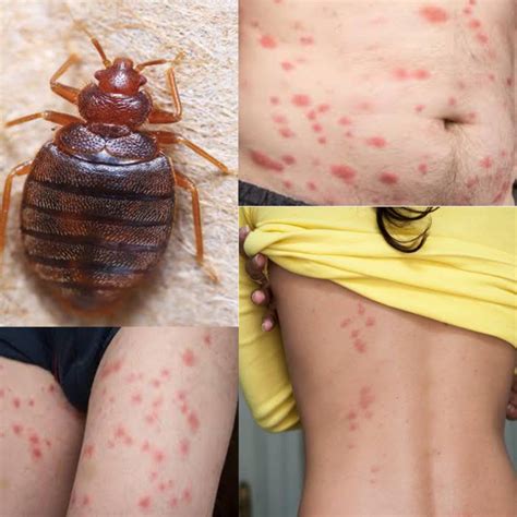 What Do Bed Bug Bites Look Like? (Pictured) - Public Health