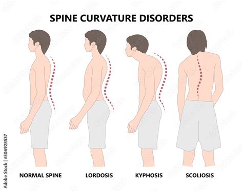 spine forward head posture chest xray neck pain lumbar Scheuermann's ...