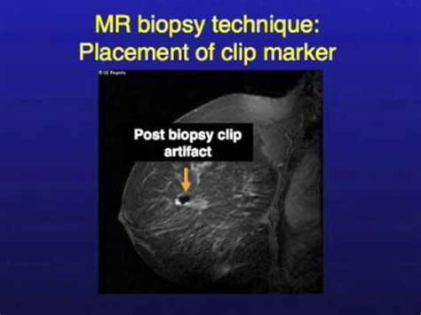 UCSF Radiology: How MRI Image Guided Breast Biopsies Are Done - YouTube