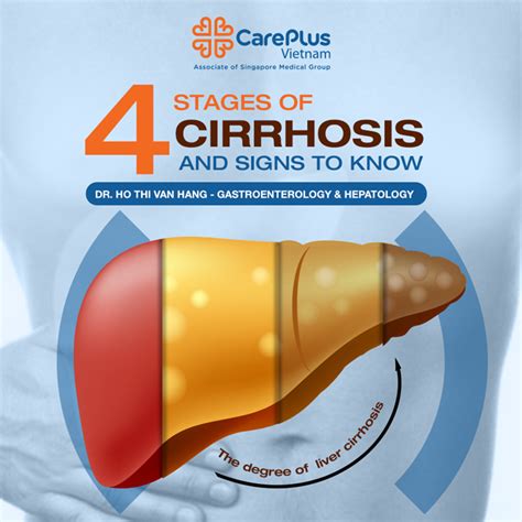 4 Stages of cirrhosis and sign to know