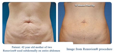 Lipo and Renuvion vs. Tummy Tuck - Omaha Liposuction by Imagen