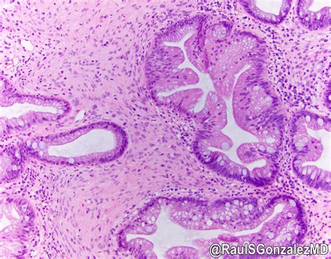 Sessile Serrated Adenoma Histology