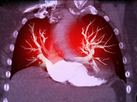 CTA Chest or CTPA with Contrast Media 3D Rendering for Diagnostic Pulmonary Embolism (PE Stock ...