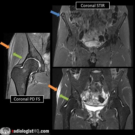 Iliotibial Band Syndrome Radiology Iliotibial Band Syndrome Mri ...