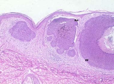 Superficial Basal Cell Carcinoma Histology