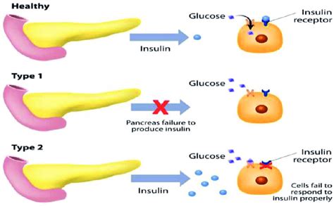 Insulin resistance during gestational diabetes [54]. | Download Scientific Diagram