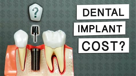 Best Dental Implants in Bangalore - Best Dental clinic in Bangalore