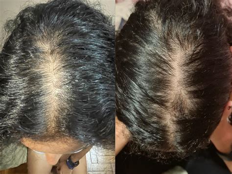 Stopping Androgenic Alopecia in Women - Marilia's testimonial ...