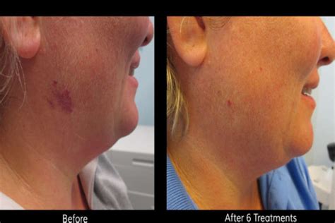 Laser Birthmark Removal: Procedure, Side Effects And Costs (Before & After Pics)