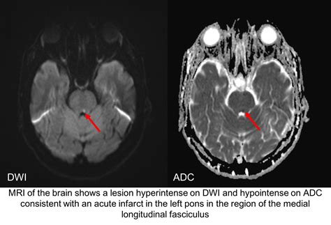 Internuclear ophthalmoplegia – Case-Based Neuro-Ophthalmology