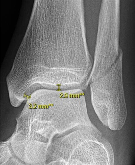 Regular mortise radiograph with a Medial Clear Space (MCS) of 3.2 mm... | Download Scientific ...