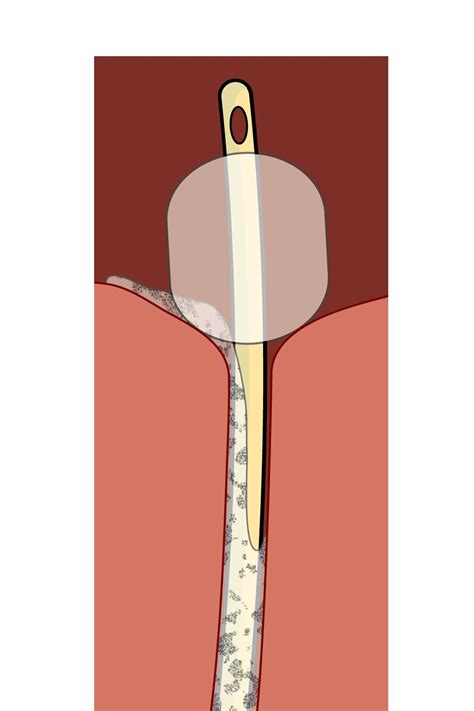 What is a catheter?