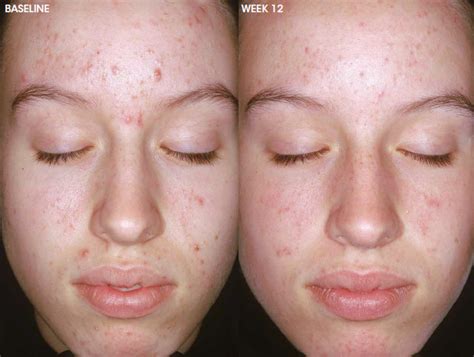 Aczone Acne Treatment | YoDerm