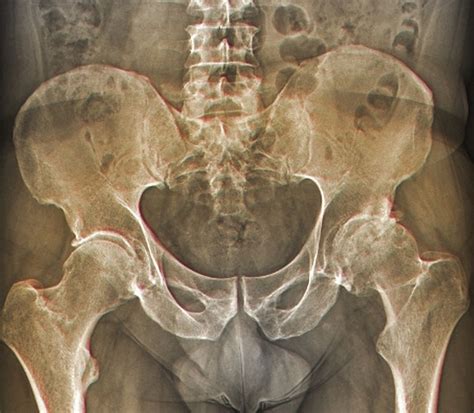 Bone-On-Bone Osteoarthritis