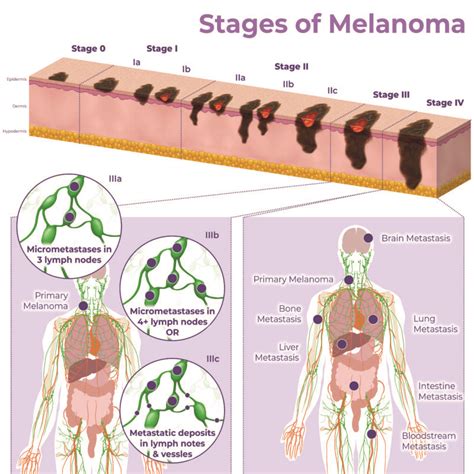 Melanoma Skin Cancer Diagram