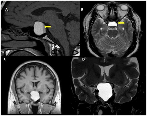 IJMS | Free Full-Text | Pituitary Apoplexy: Risk Factors and Underlying ...