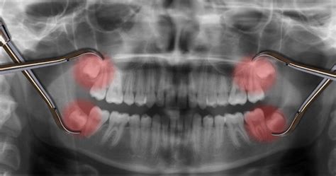 What You Need to Know About Wisdom Teeth Removal