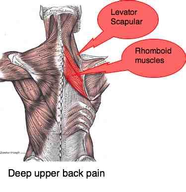 Deep upper back pain can be very difficult to diagnose and manage.