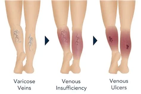 Venous Ulcer Treatment in Los Angeles, CA | ProVascularMD