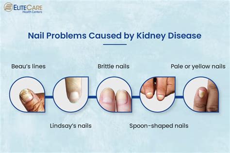 How Does Kidney Disease Affect Nail Health? | EliteCare HC