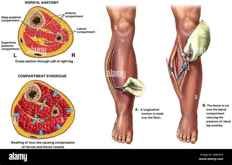 Lateral compartment of leg hi-res stock photography and images - Alamy