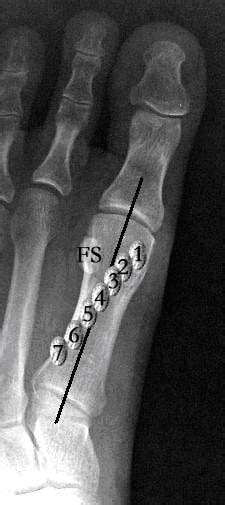 Tibial sesamoid fracture | The Foot and Ankle Online Journal