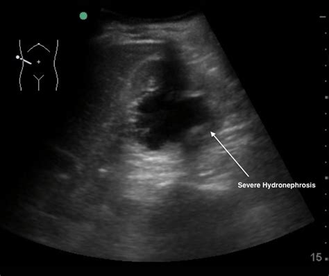 Severe Hydronephrosis | Emory School of Medicine