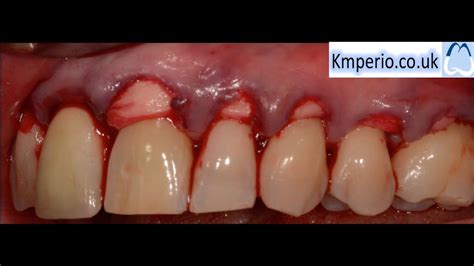 Alloderm Periodontal Surgery for Gum Recession/Grafting/Root Coverage-Upper Teeth. - YouTube
