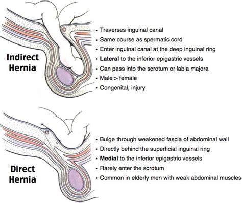 Best 25+ Hernia inguinal ideas on Pinterest | Very funny memes, Very ...